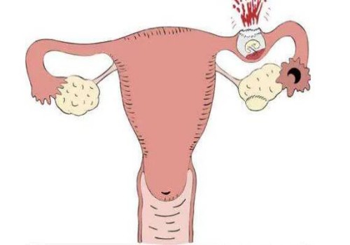 试管婴儿二代和一代的成功率，哪个高一目了然